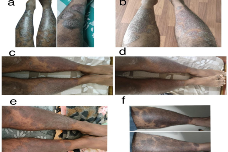 Shows the physical examination of the patient, (a) before secukinumab treatment, (b) after 0h dose, (c) after 1