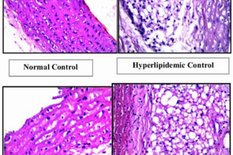 Fig 1. Histopathological study of the effect of ethanolic extract of leaves of Bryophyllum pinnatum on the aorta in hyperlipidemic cocktail induced hyperlipidemia in rats