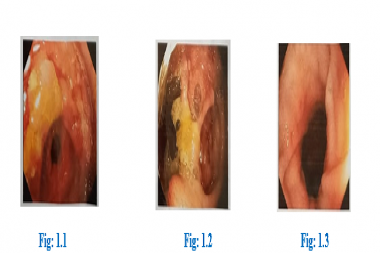 Colonoscopy revealed large multiple ulcers with patulous ileocecal valve