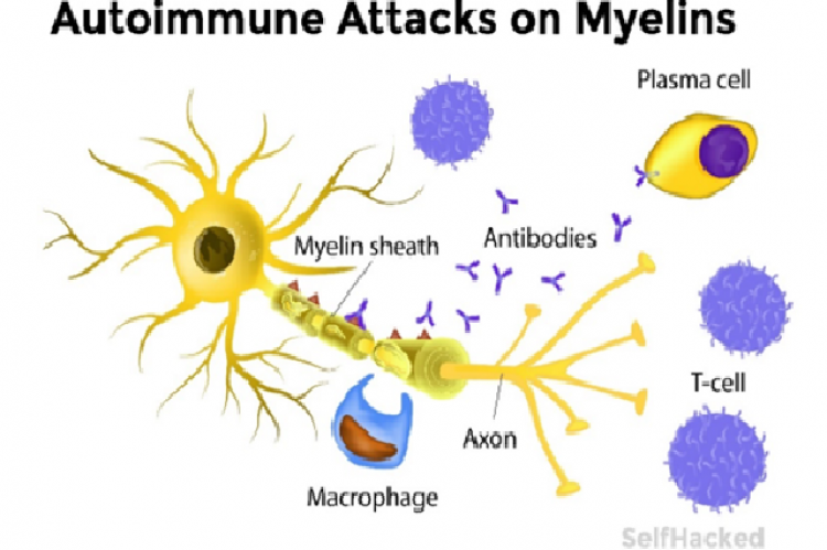 https://medium.com/@mstreatment/multiple-sclerosis-risk-factors-dafc58824961.