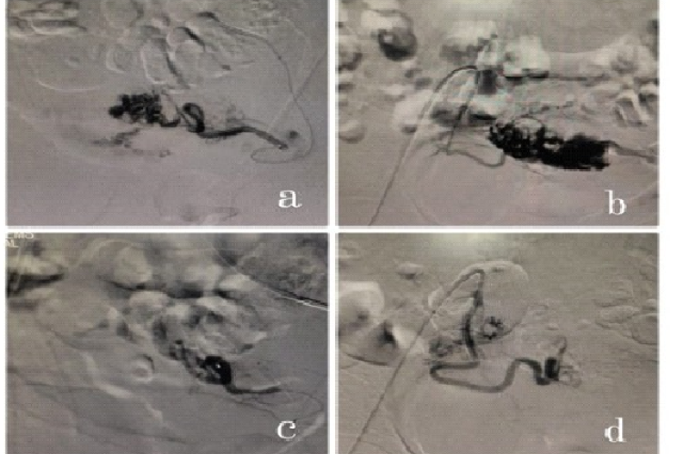 Hysteroscopic images showing a) Left uterine artery pre embolization. b) Right uterine artery pre embolization. c) Right uterine artery post embolization. d) left uterine artery post embolization.