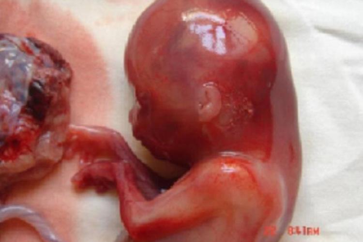 Abortus showing cystic hygroma