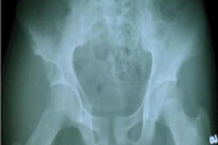 Radiograph of pelvis with both hips showing elongation of neck of right femur with overlying soft tissue swelling shadow
