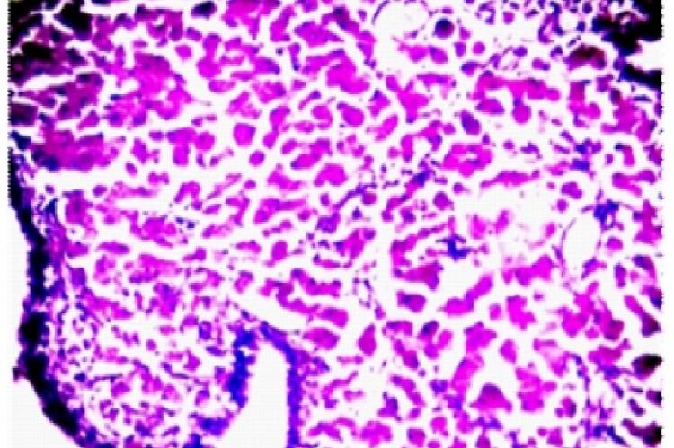 Lamina propria containing histiocytes showing PAS positivity (100X)