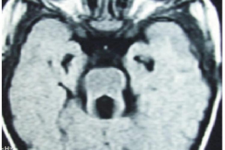 AXIAL T1 MRI image showing vermis hypoplasia and slimming of isthmus in brain stem