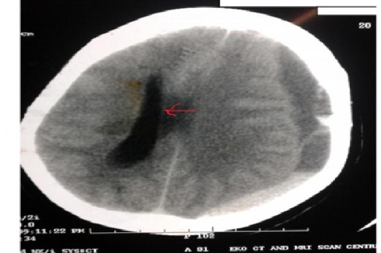  Computed Tomographic scan of brain showing the left sided SDH with midline shift (arrow)