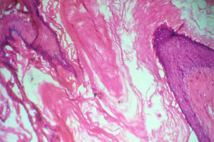 Epidermal cyst of breast, histologically showing thin epidermal epithelium and pools of keratin material (H & E Stain. 150X)