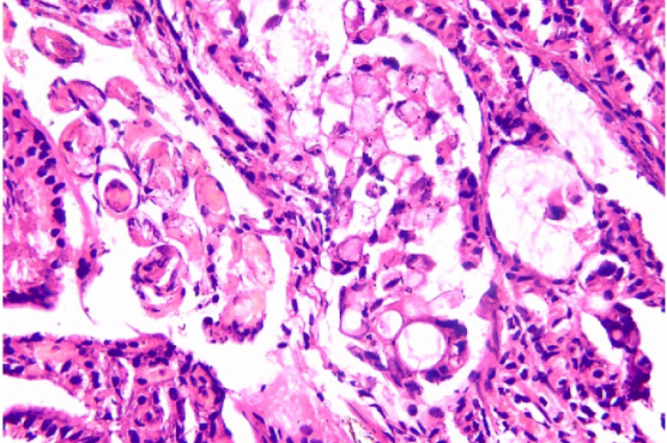  Histopathology showing signet ring cell adenocarcinoma of stomach ( H & E X 400)