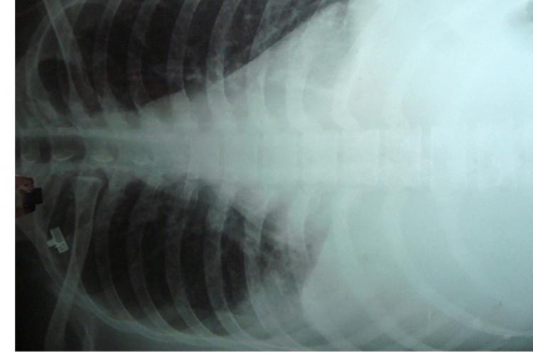 Figure showing the right sided pleural effusion in our patient