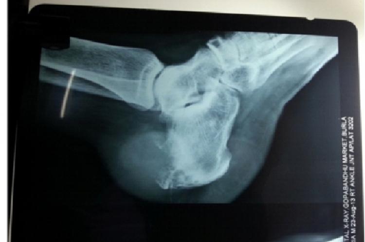 X-ray showing osteolytic lesion involving calcaneum