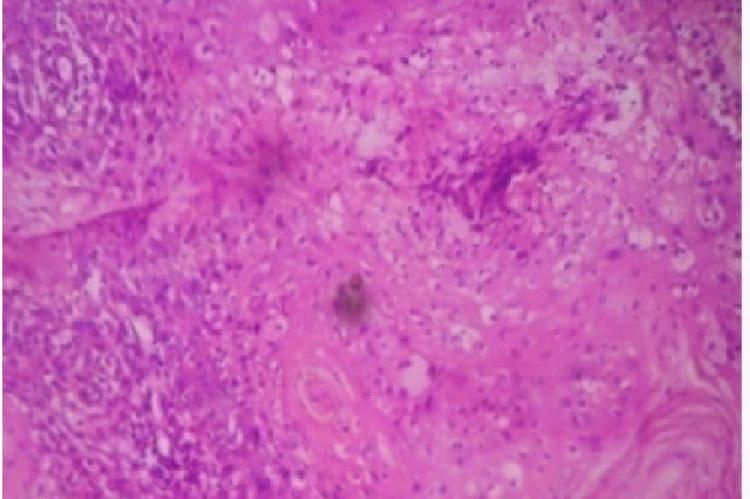 Photomicrograph of primary Squamous cell carcinoma nasopharynx on histopathology