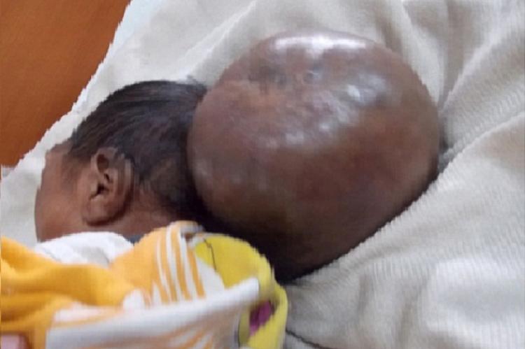 Large meningoencephalocele arising from occipital region