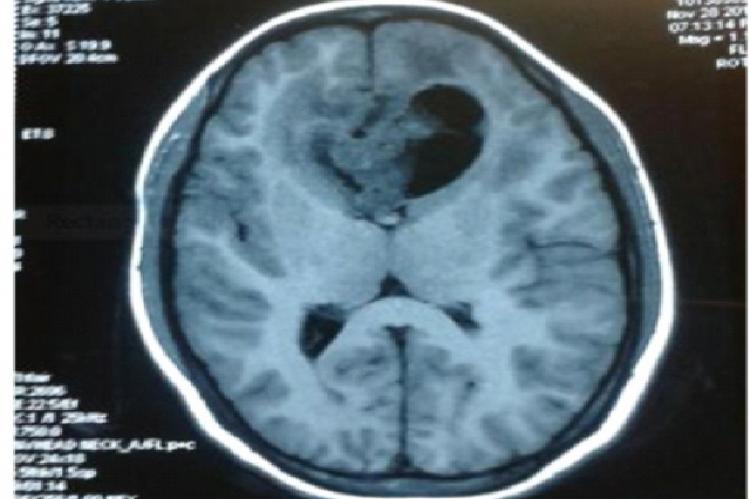 Preoperative MRI without contrast T1 flair axial view showing poorly marginated