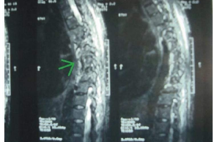 Pyoperitoneum secondary to paraspinal cold abscess rupture