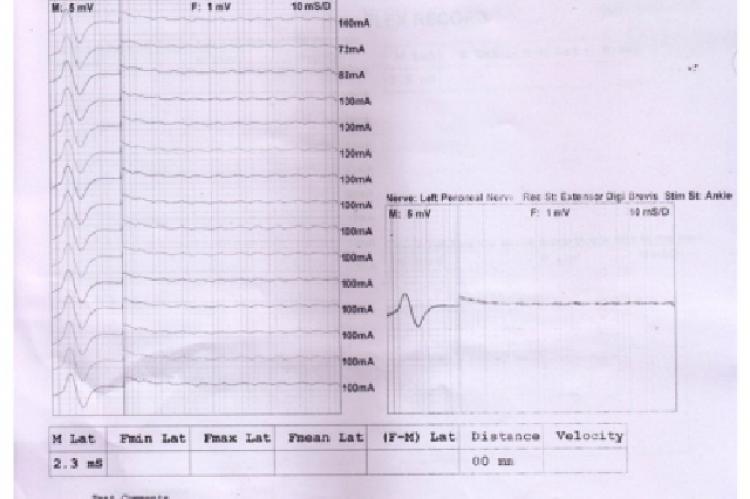 NCV study of the patient showing absent F waves in lower limb