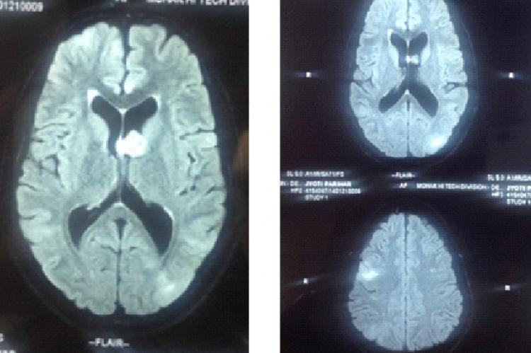 MRI Brain showing Subependymal Giant Cell Astrocytoma of left Frontal Horn with white matter radiation lines