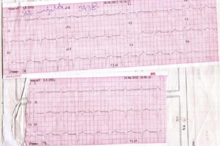 His ECG showed LBBB with pacing spikes