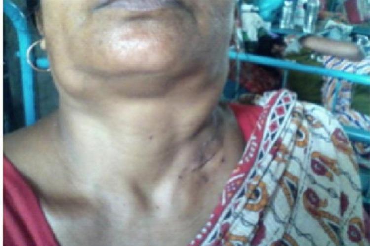 The massive lymph nodes on both sides of neck of the patient