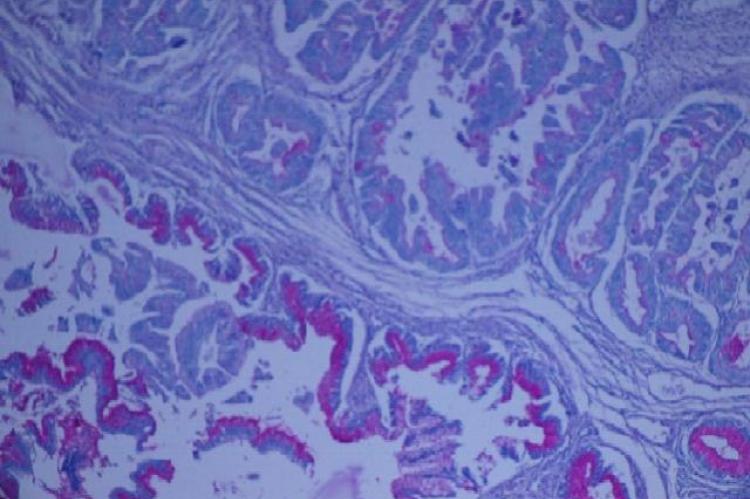 PAS stained multiloculated areas sepreated with fibrous septa