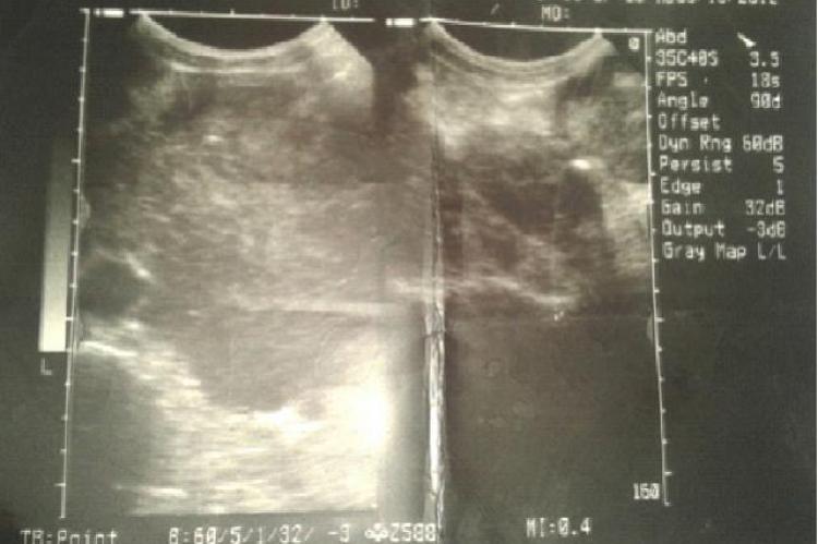 HUltrasonography of case of seminoma of lt side undescended testis