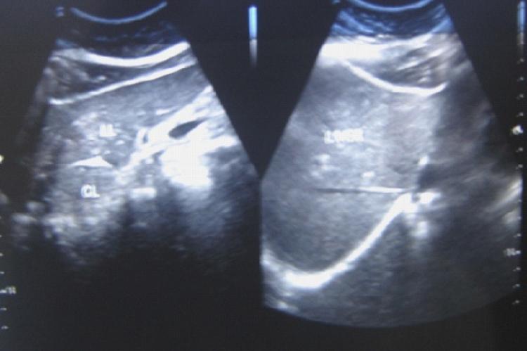 Ultrasonographic examination of the whole abdomen showed no abnormality.