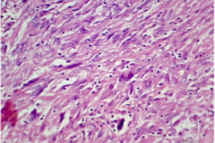 (40X, H andE shows mainly spindle shaped tumour cells with features of Anaplasia.)