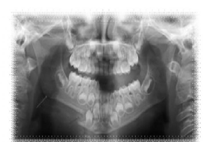 1 pre operative radiographic findings