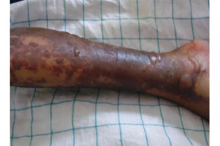 Erythematous skin lesions along with fluid filled blisters in the lower limb after application of Heparin gel.