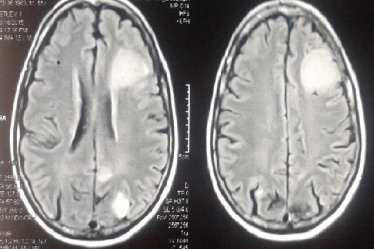 MRI brain showing multiple metastatic lesions with surrounding edema (T2 flair axial)