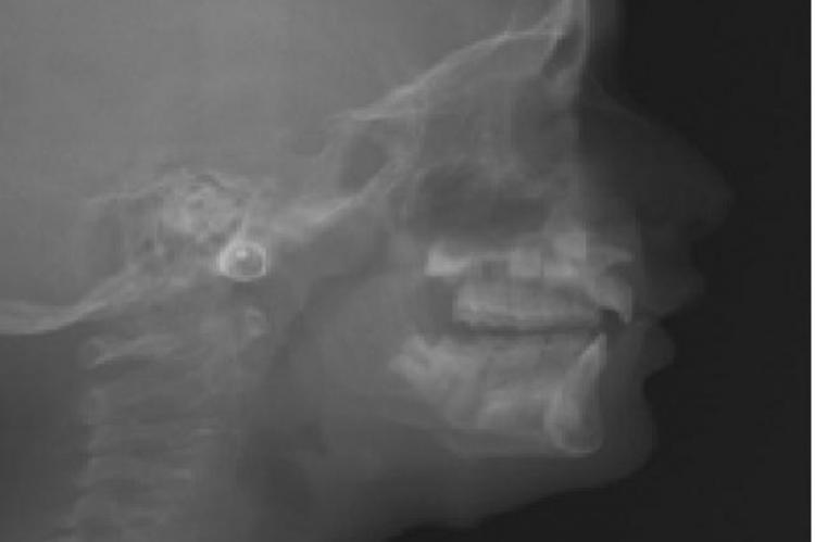 Pre treatment Lateral Cephalogram