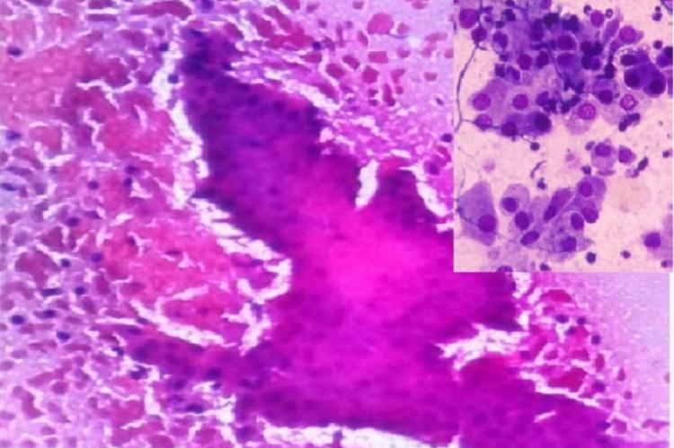 Cytology of oncocytic cells in sheets and singles