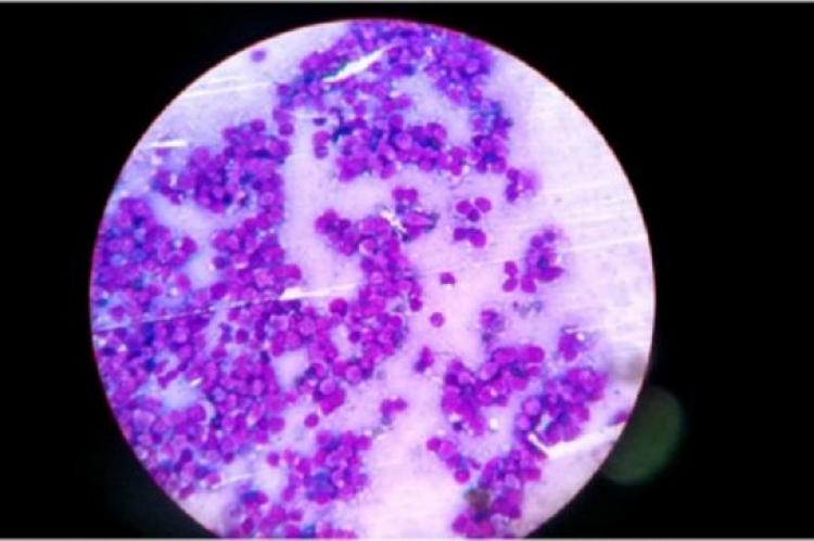 Imprint smear of the mediastinal mass showing mononuclear round cells