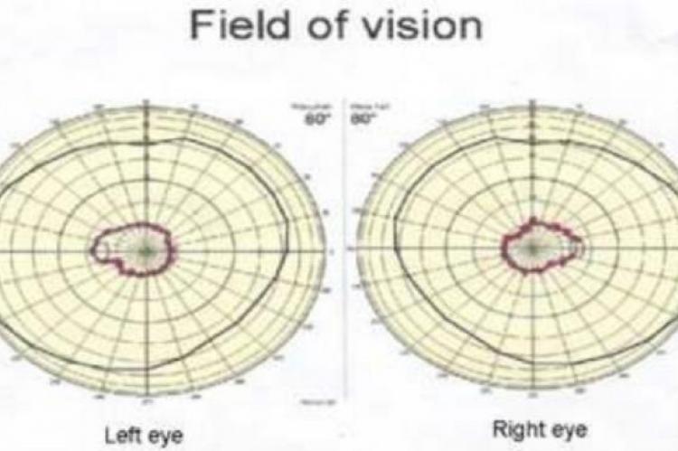 Perimetry chart: field of vision