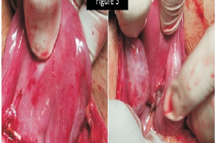 The image 3 A shows one end of the transveres arm prefloating lower anterior uteine wall