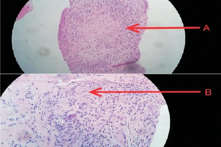 Synovial biopsy specimen showing caseous granuloma (A) and Langhans Giant cells (B)