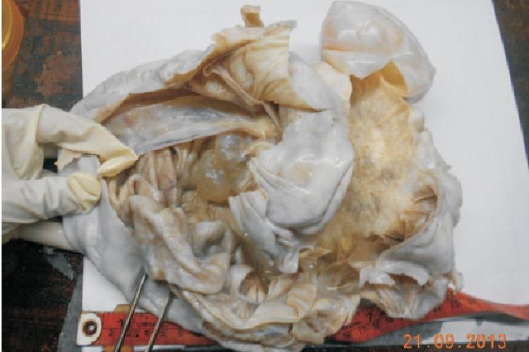 Gross specimen of Brenner tumor 
