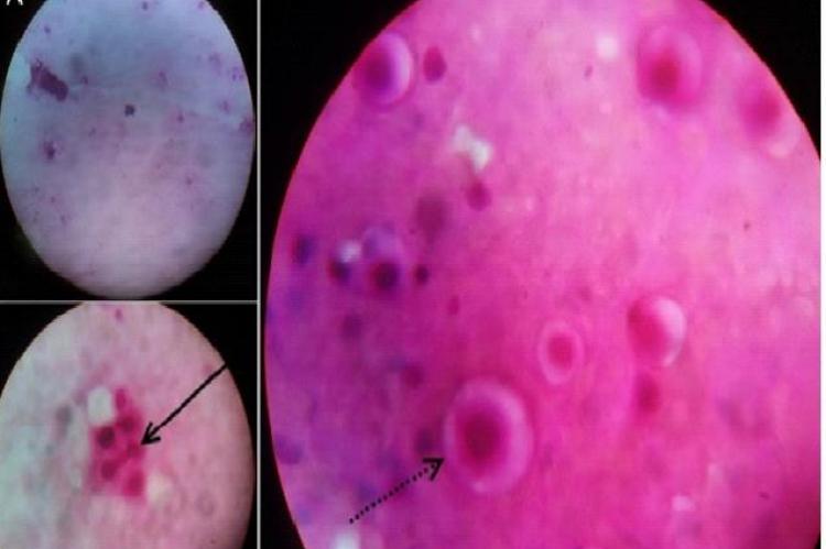 Microscopic picture of pulmonary Fine needle aspiration showing yeast cells visible in 10× magnification