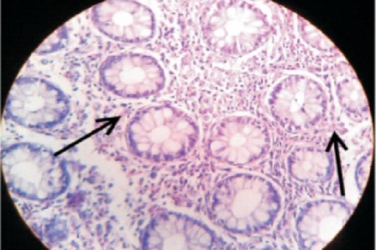 Colonic mucosa biopsy of the patient showing inflammation along with infiltration by eosinophils