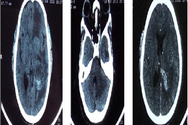 CECT scan axial section showing multiple brain metastases in left frontal, temporo-parietal region (a) & cerebellum (b), mass is compressing and displacing the left lateral ventricle (c)