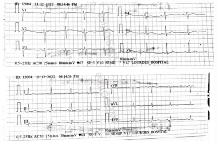 Electrocardiographic features of trastuzumab-associated left ventricular dysfunction, as illustrated in this case series.