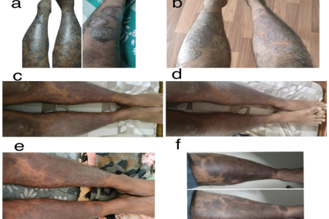 Shows the physical examination of the patient, (a) before secukinumab treatment, (b) after 0h dose, (c) after 1" dose, (d) after 2nd dose, (e) after 3d dose and, (f) after 4 dose.