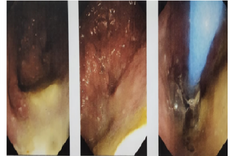 Upper GI Endoscopy showing a roomy, tortuous oesophagus