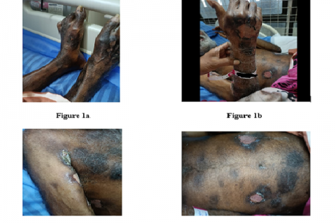 showing peeling over dorsal aspect of limbs, hands, upper arm and thigh.