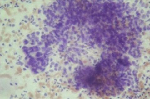 Male breast cancer metastasis to urinary bladder