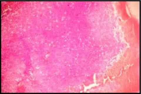 Histological diagnosis made on the basis of incisional biopsy can have pitfalls if the biopsy is not taken from the representative site, therefore, thorough examination of the excised specimen is essential for the confirmation of the diagnosis. Here we describe a case that on incisional biopsy was thought to be an invasive salivary gland tumor but the excised specimen revealed ameloblastoma, thus showing the importance of excised specimen in reaching conclusive diagnosis.