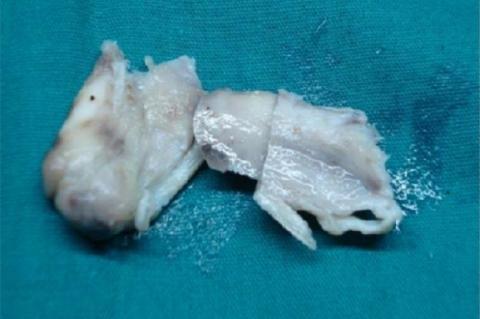 Ross photograph of mass removed from vagina