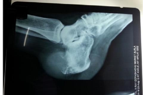X-ray showing osteolytic lesion involving calcaneum