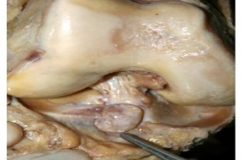 Rare intra-articular lipoma in knee joint - a case report
