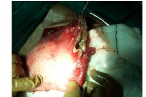 Gangrenous perforations on greater curvature of stomach