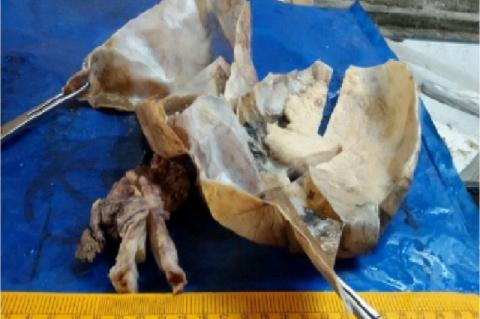 Gross -dermoid cyst with thickened hard area